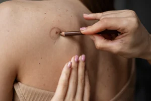 female doctor diagnosing melanoma body female patient 1 1
