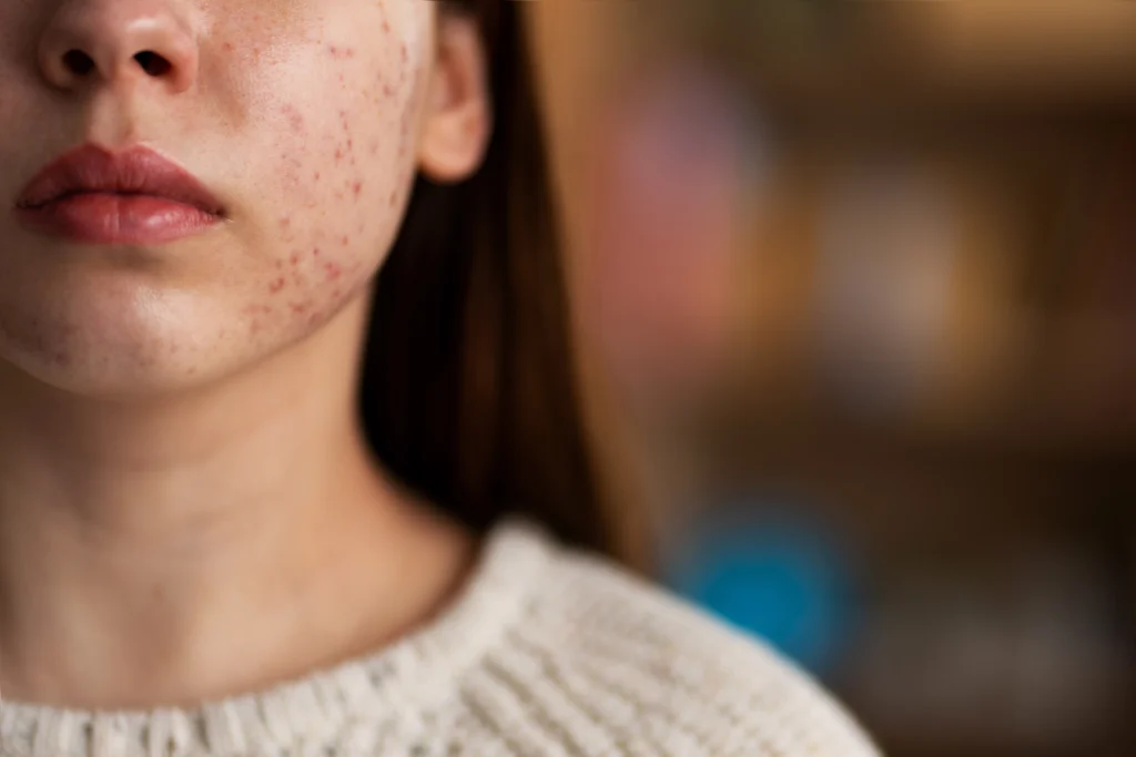 person dealing with rosacea 2