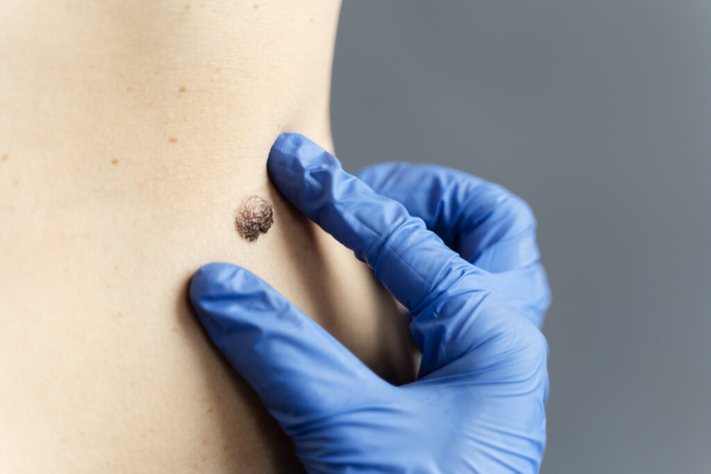 close up hand with glove measuring mole