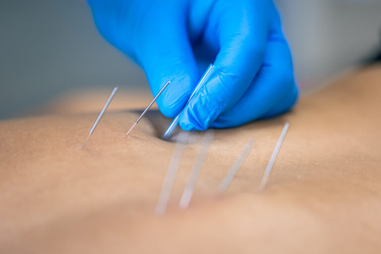 close up needle hands physiotherapist doing dry needling