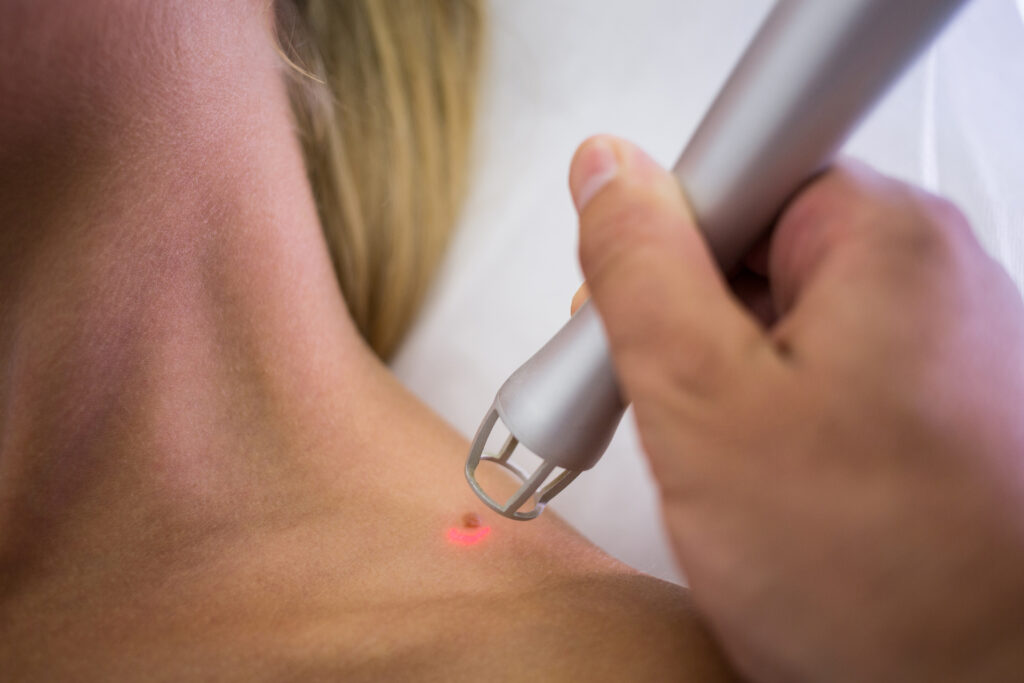 dermatologist removing mole from womans shoulder 1