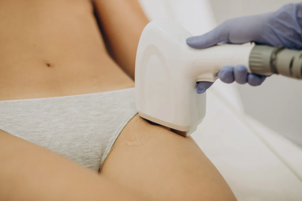 laser epilation hair removal therapy 1