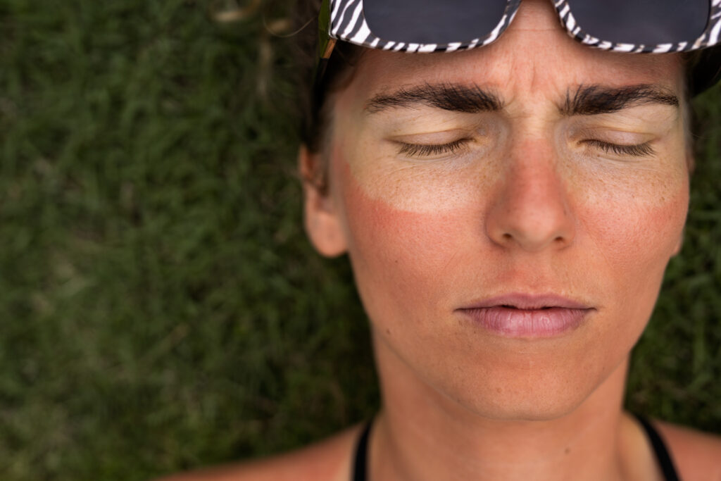 portrait adult woman with sunburn skin