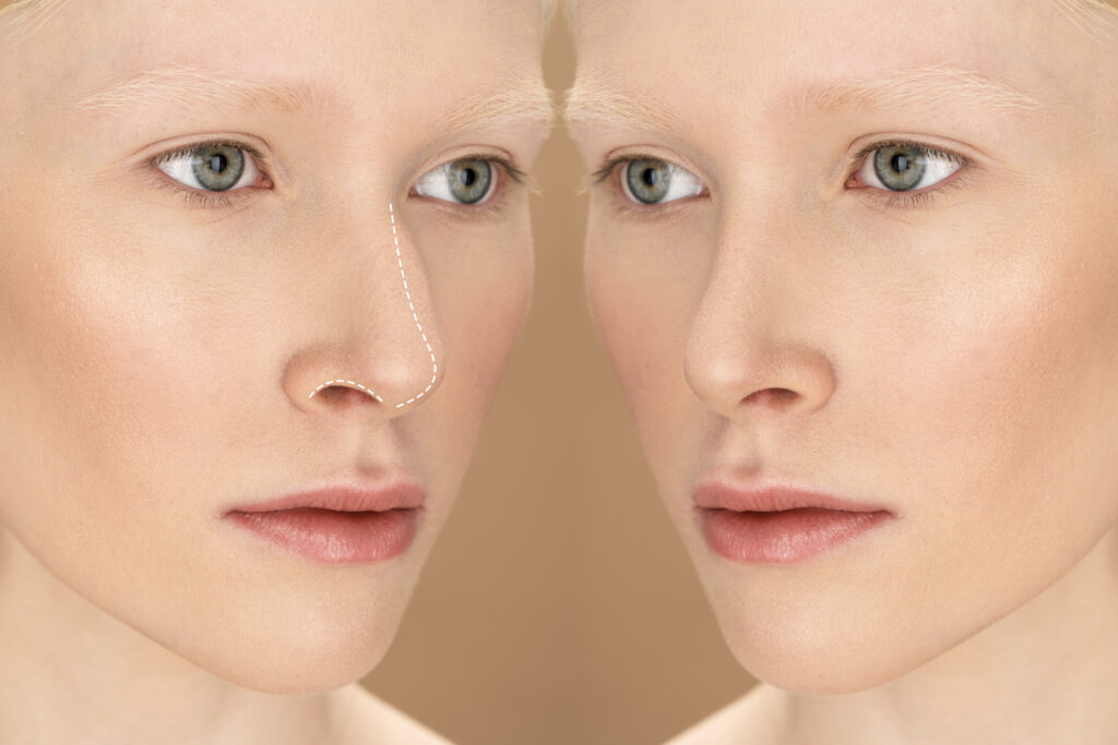 rhinoplasty surgery concept with man model