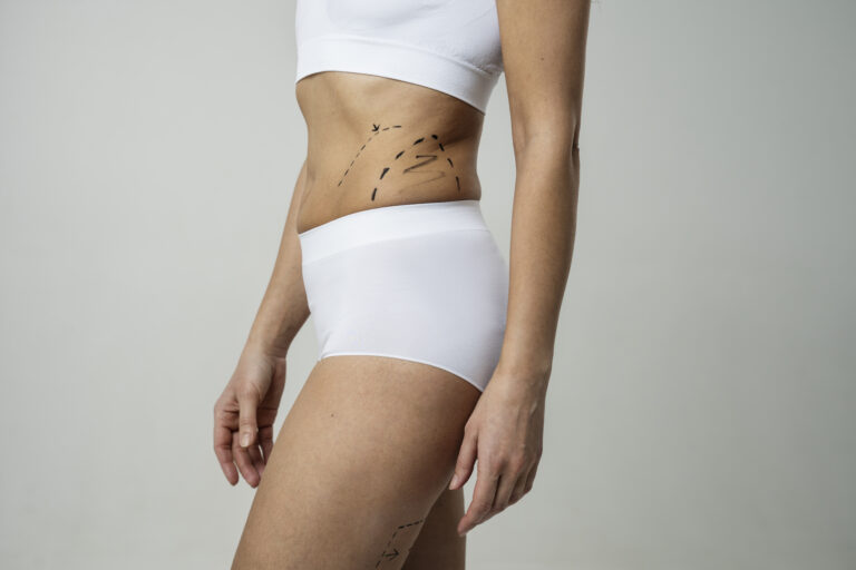 side view woman with marker traces skin
