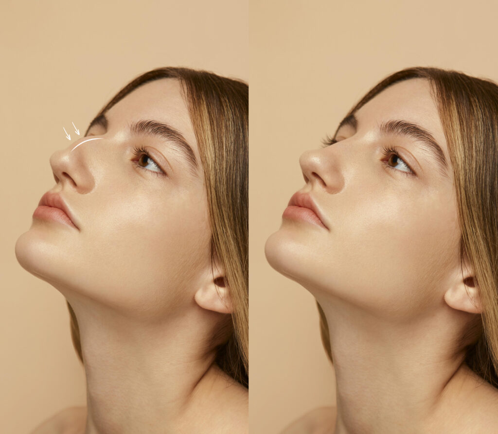 woman getting ready nose job surgery 1