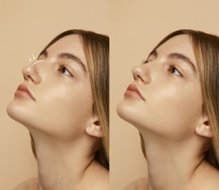 woman getting ready nose job surgery 1