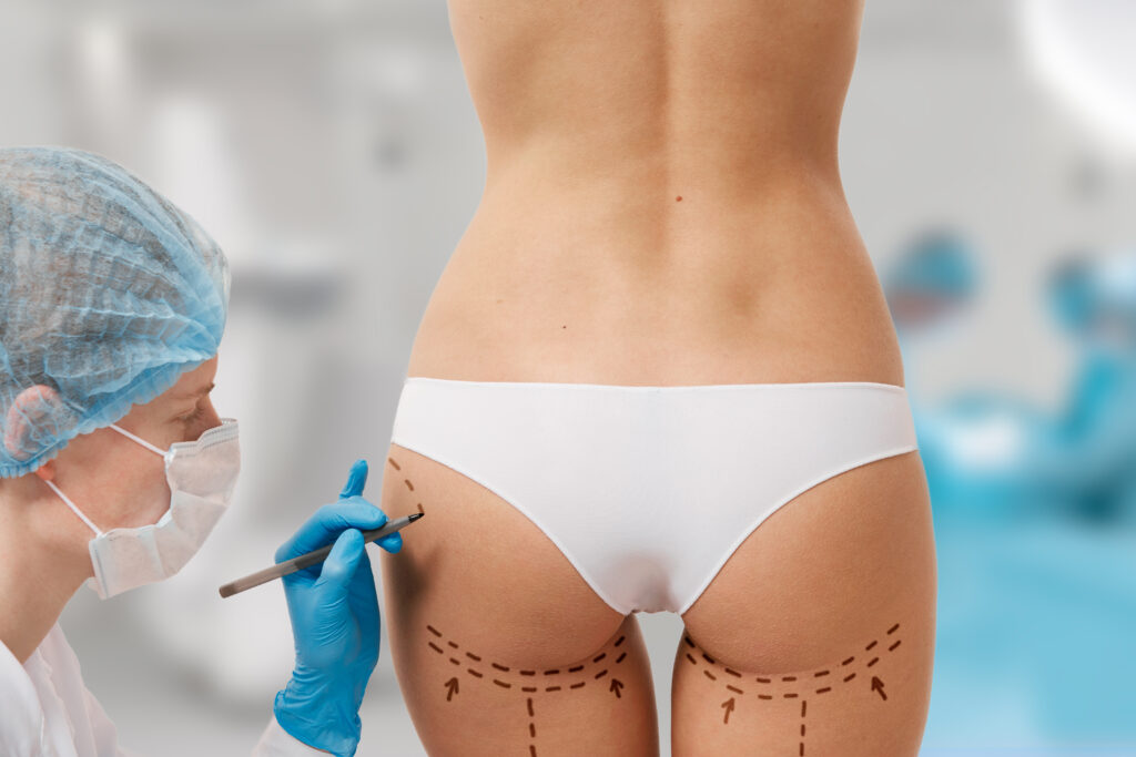 woman marked out cosmetic surgery 1 1
