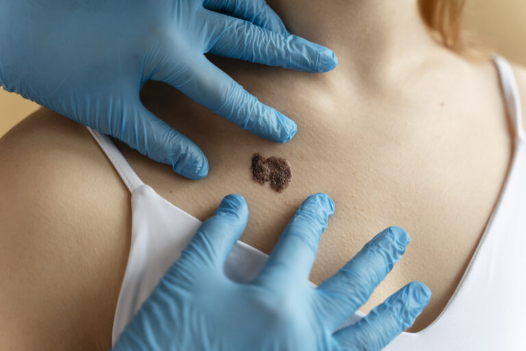 young woman with big mole chest