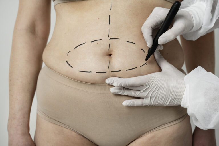 front view woman with marker traces belly