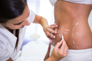 surgeon drawing lines womans abdomen liposuction cellulite removal