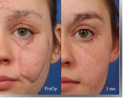 How to Get Rid of Stitch Marks—Complete Guide for Smooth, Scar-Free Skin 2 Raised vs Flat Scars
