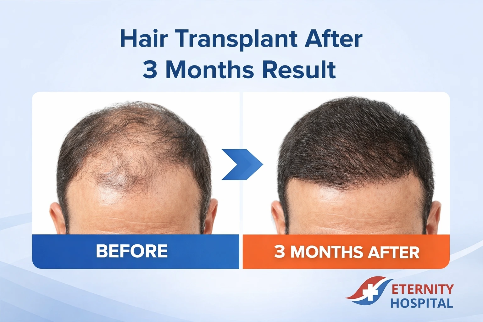 Hair Transplant After 3 Months Result: What to Expect, Growth Timeline, and Best Clinic Options