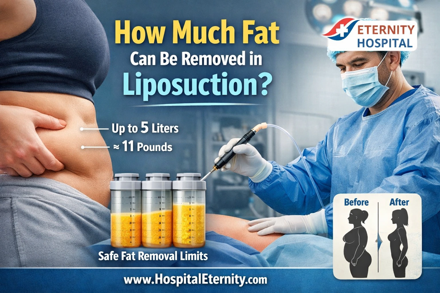 How Much Fat Can Be Removed in Liposuction?
